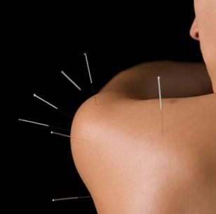 acupuncture for frozen shoulder