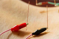 Electro-acupuncture