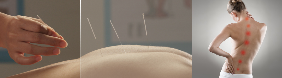 Chicago acupuncture for back pain