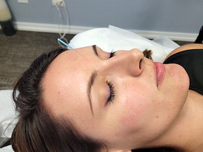 woman getting acupuncture for stress